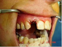 /album/galeria-de-fotos-carga-imediata-apos-exodontia-atraumatica-/carga-imediata-com-exodontia-atraumatica11-jpg/